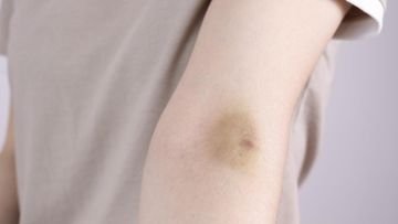 TOPINDIATOURS Update kesehatan: Mendadak Memar Tanpa Sebab? Segera Cek, Bisa Jadi Tanda Ke